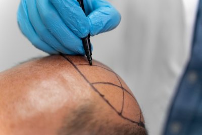 De haartransplantatie in een notendop